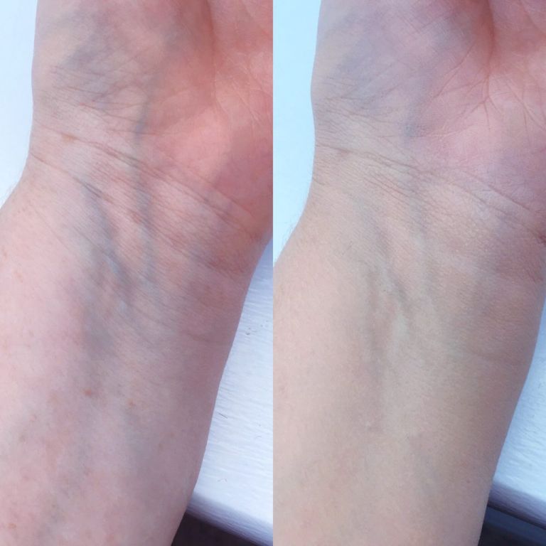 My foundation routine to cover my acne using Vichy's Dermablend | A before and after to show just how amazing the coverage of Dermablend foundation is